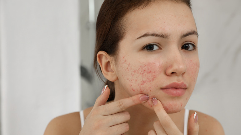 person with facial acne scars