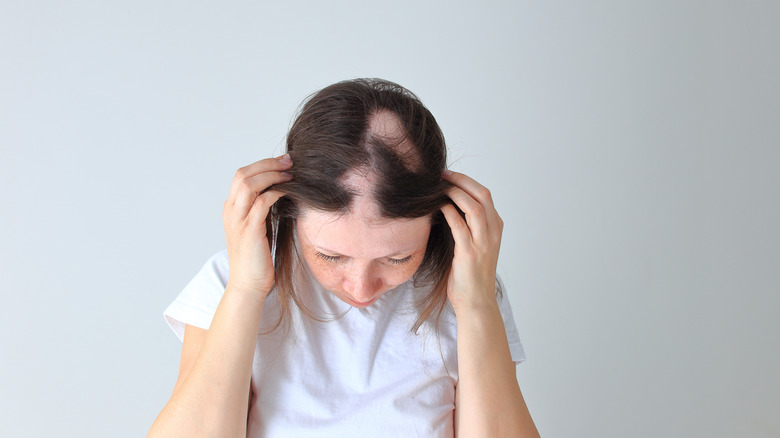 woman showing her alopecia 