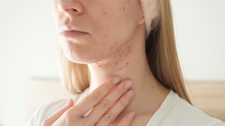 young woman touching acne around face and neck