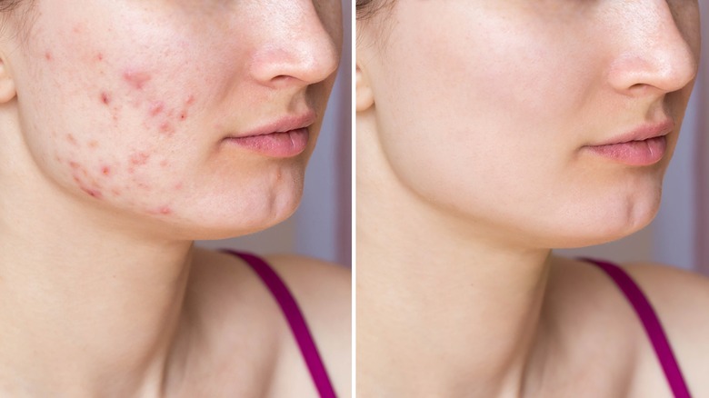 Before and after acne scars