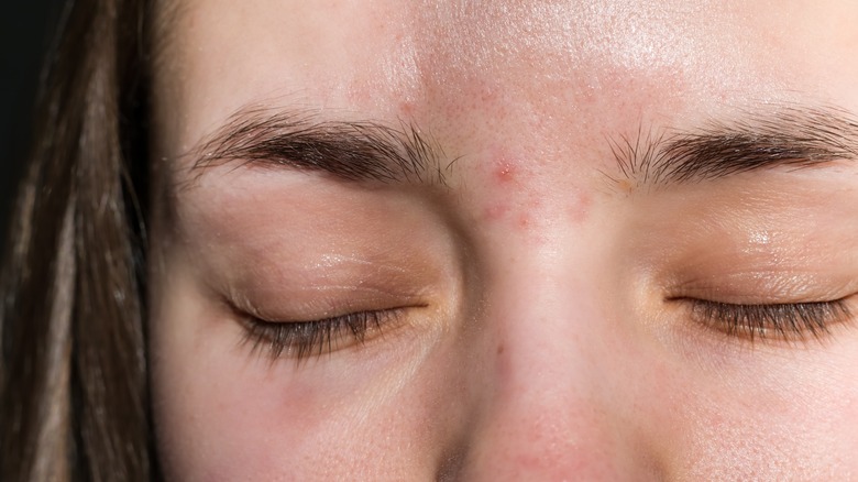 closeup of eyebrow acne