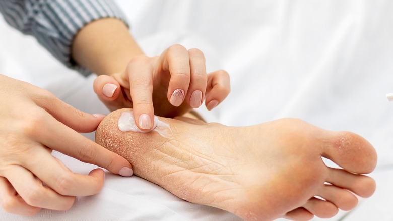 woman applying cream to cracked heels