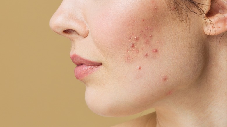 woman with acne on cheeks