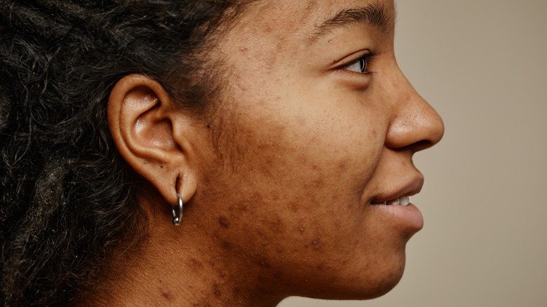 A woman with acne scars