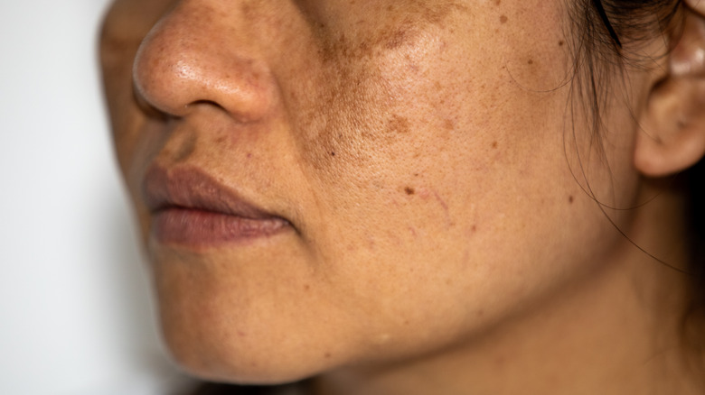 A woman with acne scars