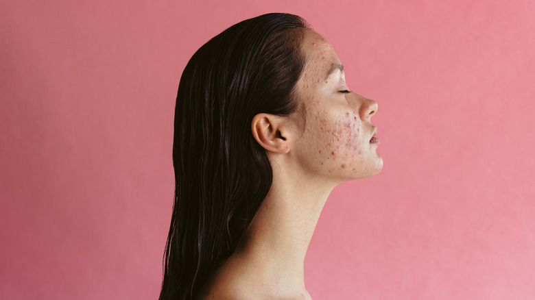 side profile of woman with acne