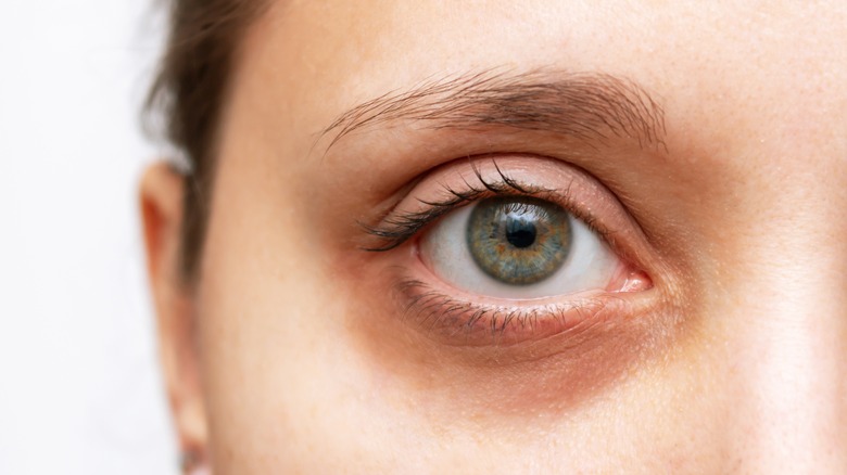 woman with dark undereye circles