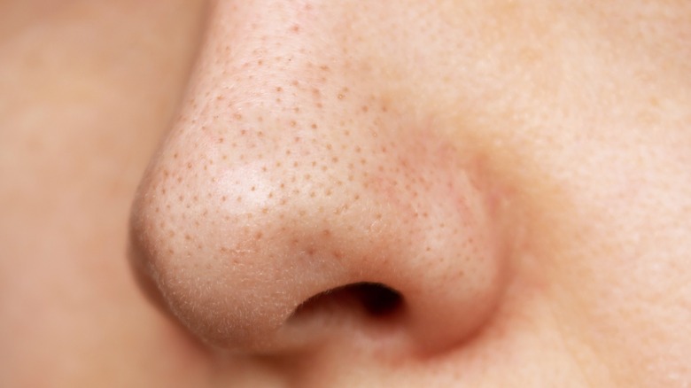 sebaceous filaments on nose