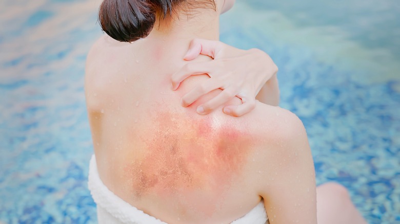 Woman scratching at sunburned back