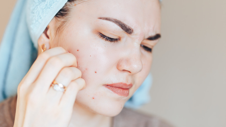 acne excoriée skin picking