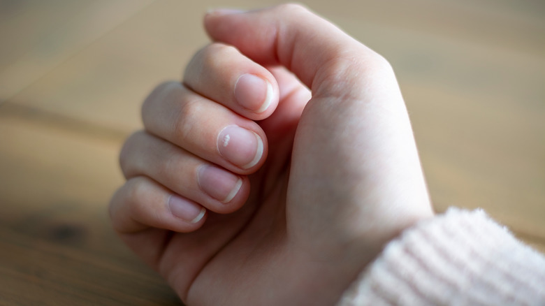 Nails that have white discoloration.