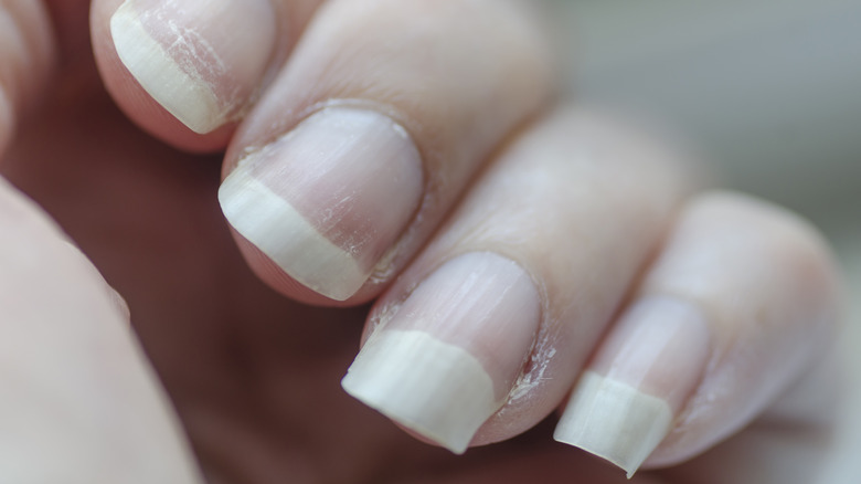 Nails that are dry and brittle.