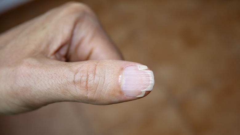 thumb nail with splits