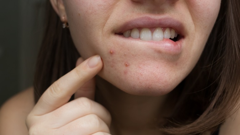 woman with hormonal chin acne