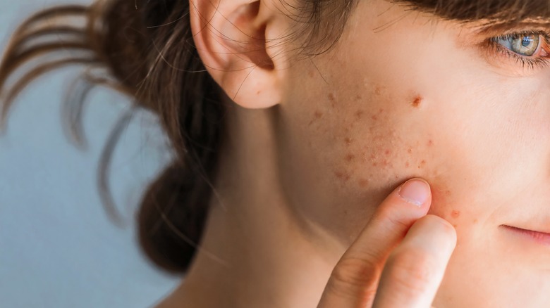 A woman with acne on her cheek