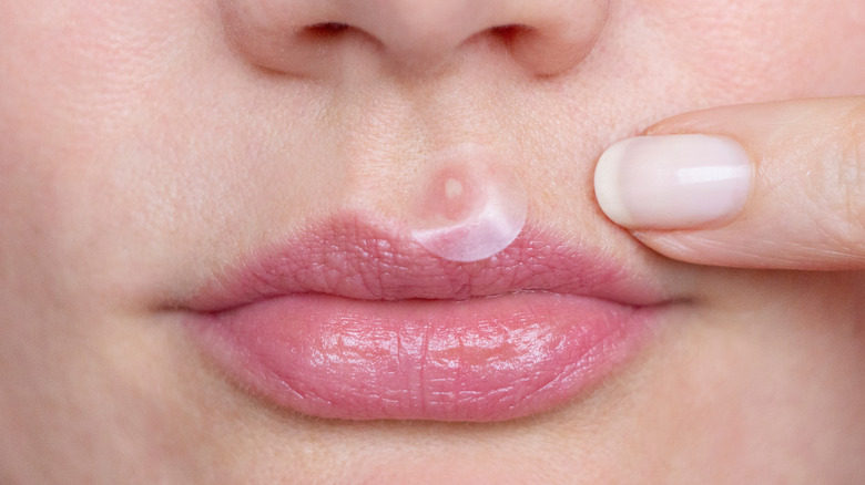 How To Treat Acne Breakouts Around Your Mouth