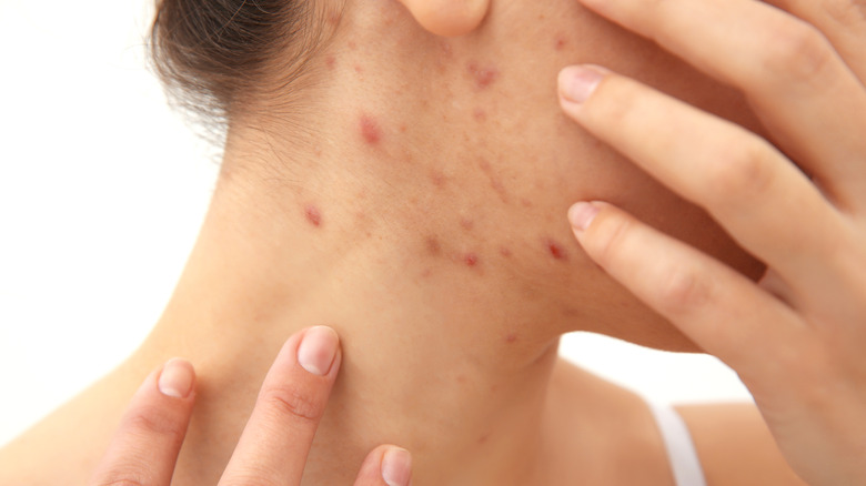 woman with acne on neck 