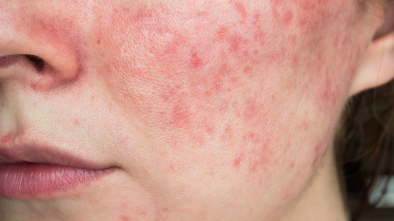 Irritated skin on a woman's cheeks