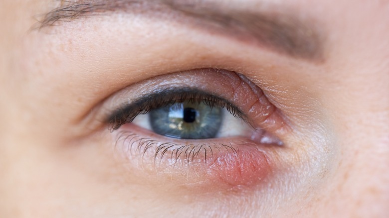 woman with itchy red eyelid