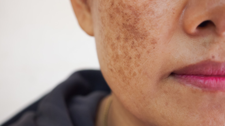 Close up of woman's face with melasma