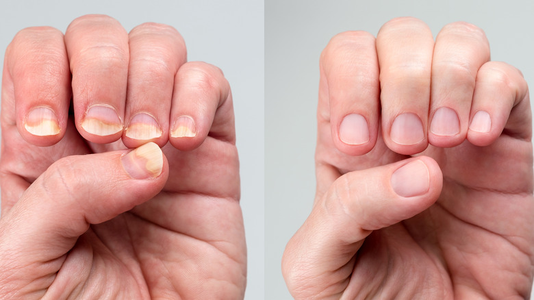 yellow brittle nails