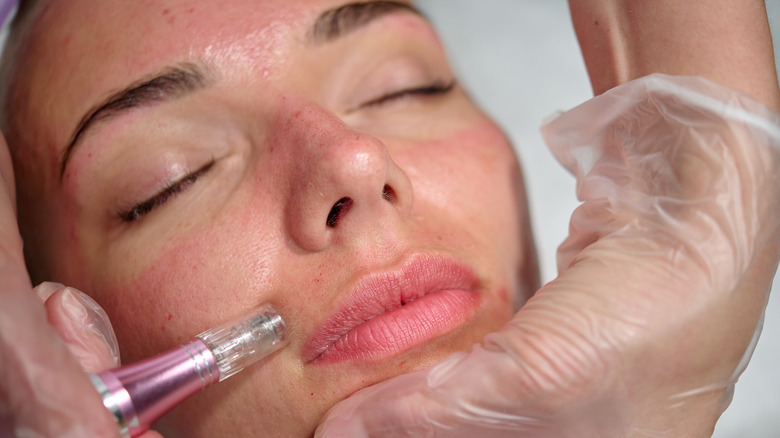 radiofrequency microneedling tool on face