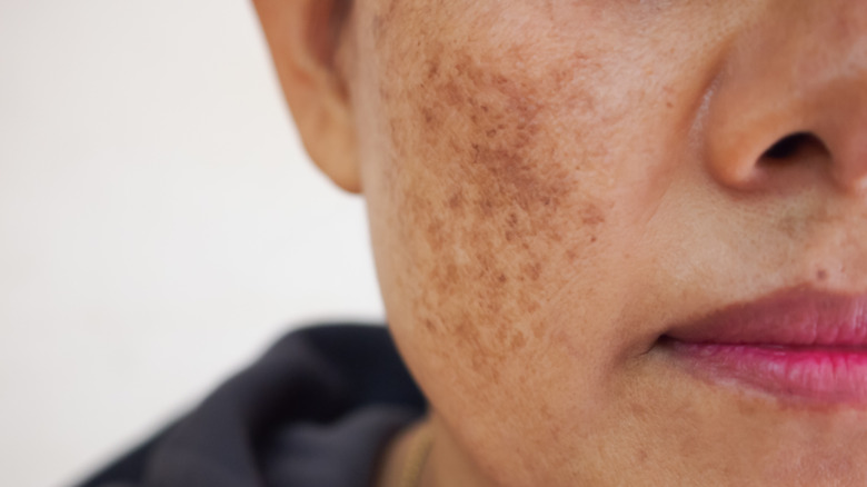 Woman with melasma on her cheeks