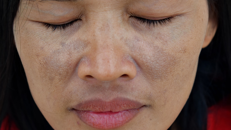 Face with melasma