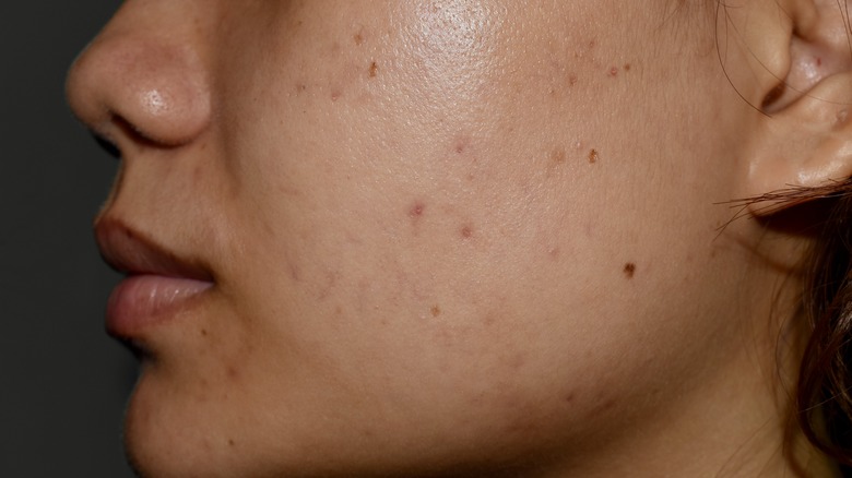 Tan skin with dark spots