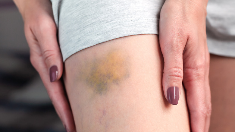 A bruise on a thigh