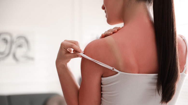 woman noticing sun burn on shoulder