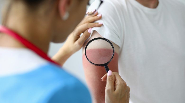 doctor examines sunburn on arm