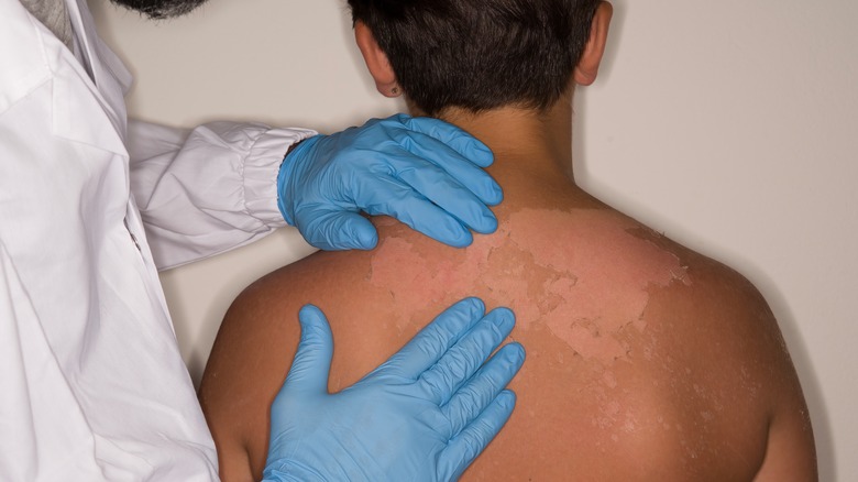 doctor examining peeling skin