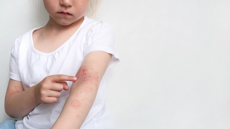 Child with eczema