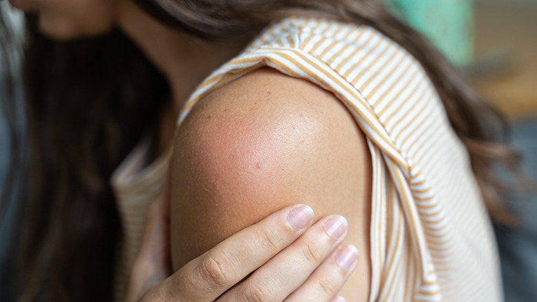 woman with red and swollen arm