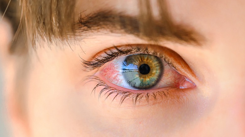 woman pink eye infection