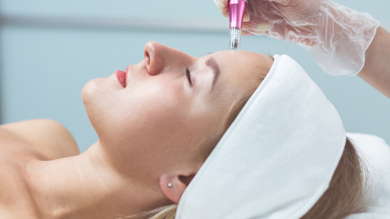 microneedling