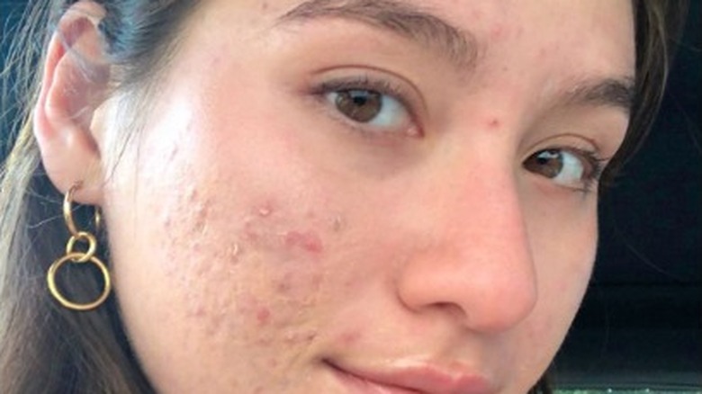 close up of woman on accutane