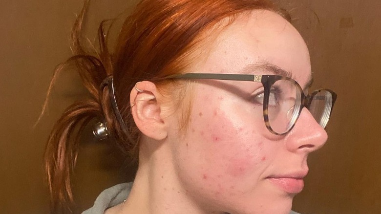 woman with acne looking off to the side