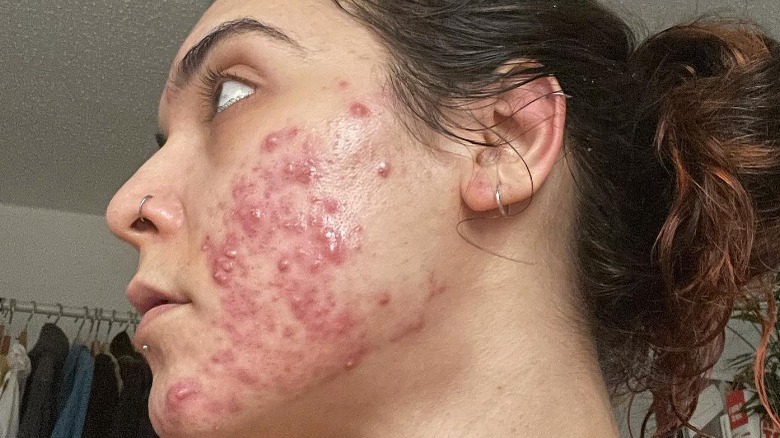 woman with cystic acne