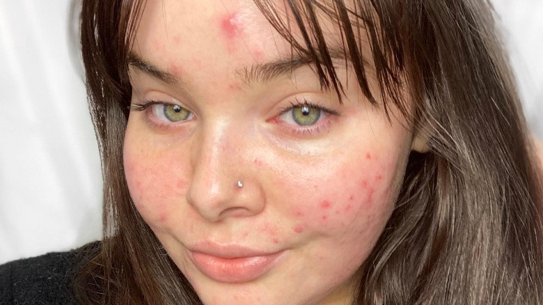 woman with acne