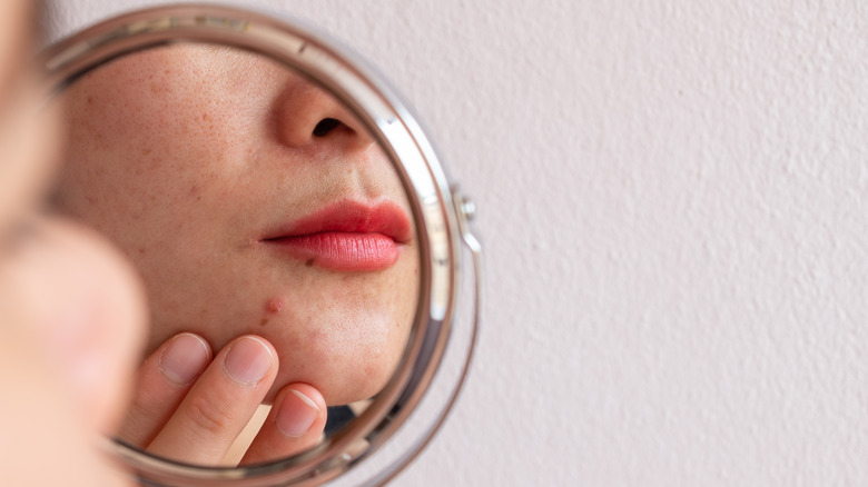 A woman looking at her acne in a mirror