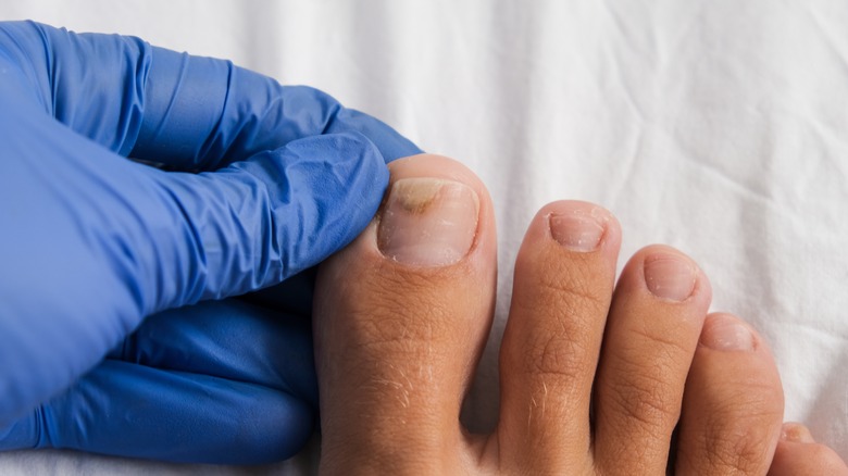 Doctor inspecting nail fungus