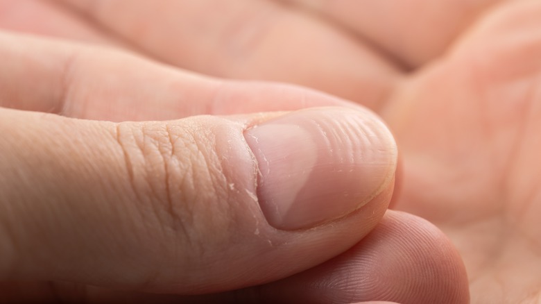 horizontal grooves in nails