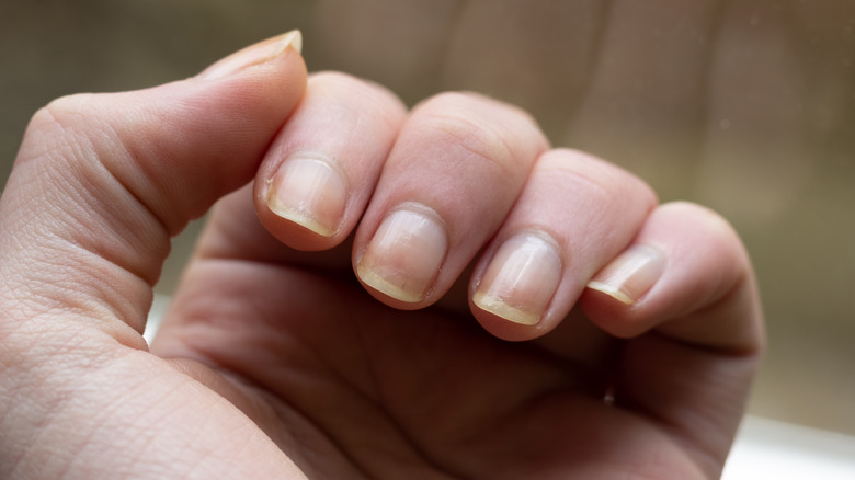 yellow finger nails on hand