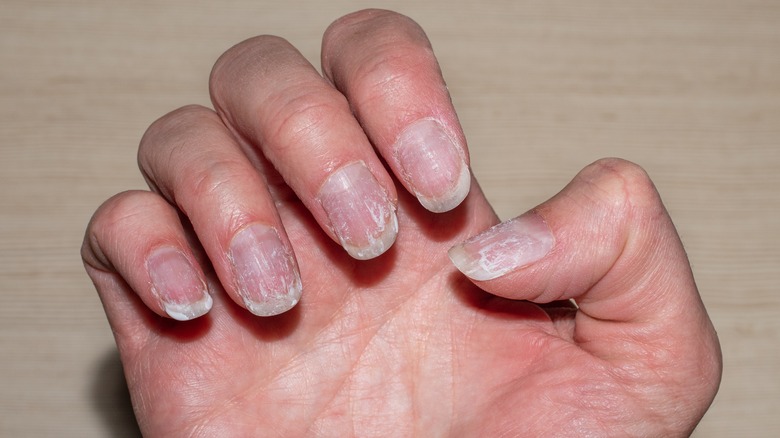 Damaged nails after gel polish