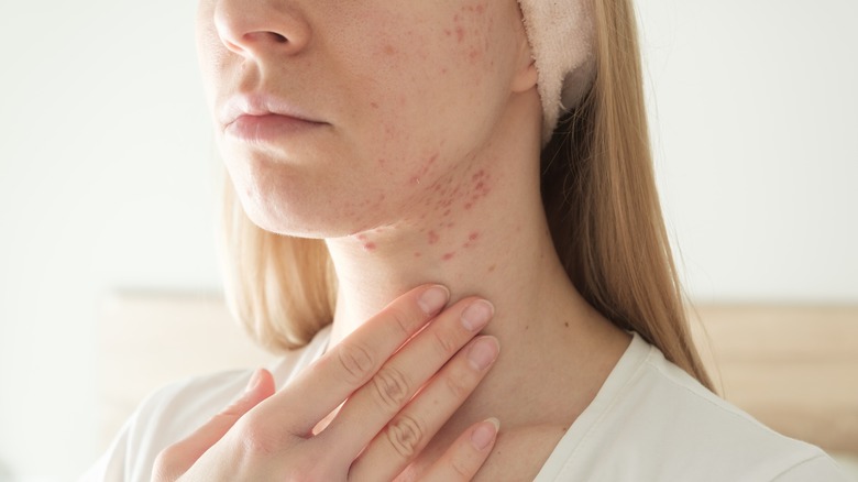 woman with acne on face and neck