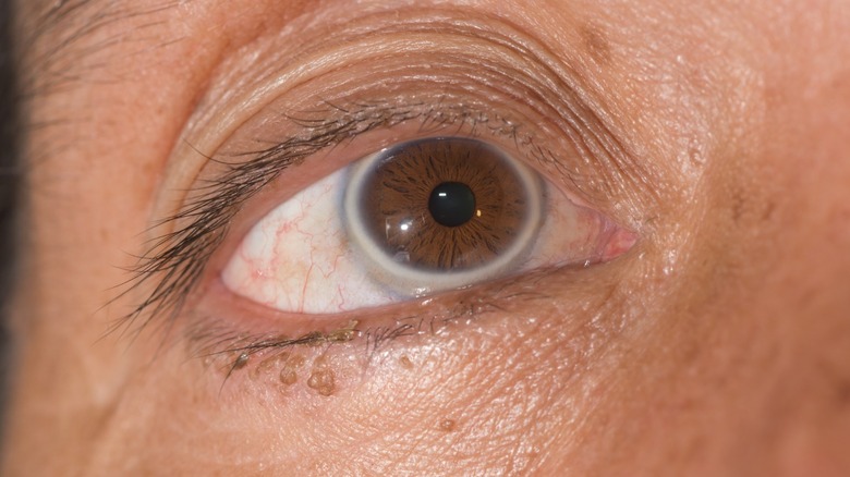 Close up of an older person with arcus senilis