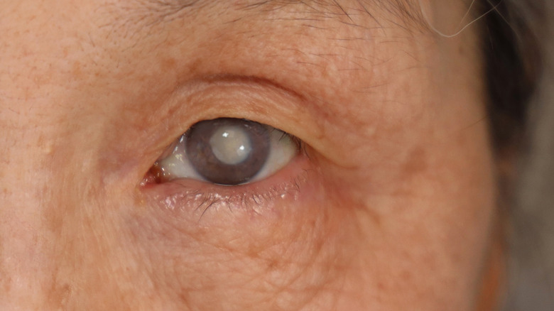 Close up of an older person with cataracts