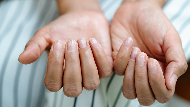 Woman with peeling brittle nails